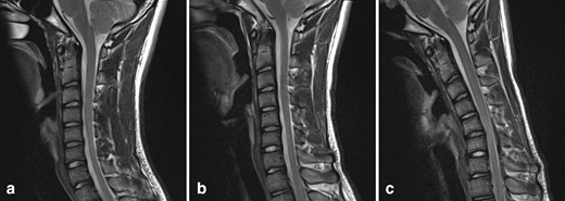T2W sagittal images of the cervical spine: (a) in a neutral position, (b) in partial flexion, (c) in full flexion. With increasing neck flexion, there is anterior displacement of the thecal sac and spinal cord. In full flexion, the thecal sac contacts the posterior longitudinal ligament and posterior C5–C6 vertebral bodies. There is a corresponding widening of the dorsal epidural space.