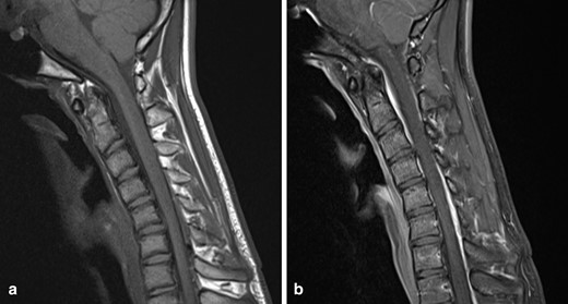 (a) T1W sagittal image of the cervical spine with the neck in flexion demonstrates anterior displacement of the thecal sac, an increased laminodural distance and enlarged dorsal epidural space (b) Post-contrast T1W sagittal image in the same position demonstrates a crescent-shaped enhancing dorsal epidural space