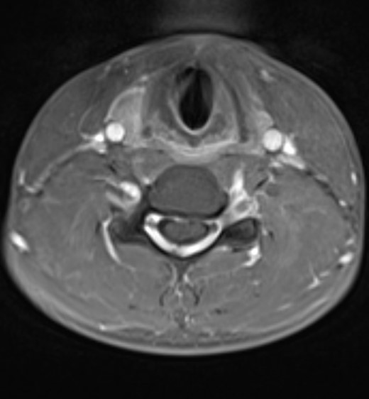 Post-contrast T1W axial image at the C5 level demonstrates anterior displacement of the thecal sac and cervical spinal cord which contact the posterior longitudinal ligament and C5 vertebral body. There is homogeneous enhancement of the widened dorsal epidural space due to the presence of a dilated internal vertebral venous plexus