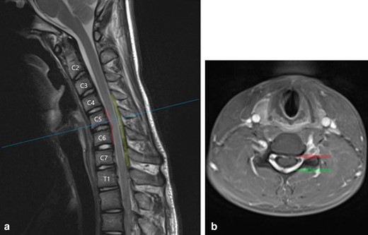 (a) T2W sagittal image of the cervical spine in full flexion demonstrates the characteristic findings in Hirayama disease: localised atrophy of the cervical cord between C5 and C7, ventral displacement of the dura and cord which contact the C5 and C6 vertebral bodies (indicated by red line), and an enlarged crescent-shaped dorsal epidural space (indicated in green) (b) T1W post-contrast axial image at the C5 level demonstrates anteroposterior flattening of the spinal cord which is displaced ventrally. The anterior dura contacts the C5 vertebral body (red arrow) and there is homogeneous enhancement of the dorsal epidural space (green arrow)