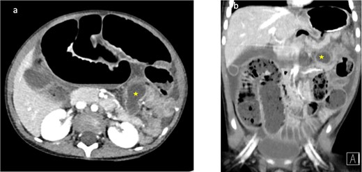 (a, b) Corresponding axial and coronal CT imaging demonstrating high-grade small bowel obstruction with a transition point seen leading to a dilated tubular structure measuring 18 mm seen within the left upper quadrant (yellow star)