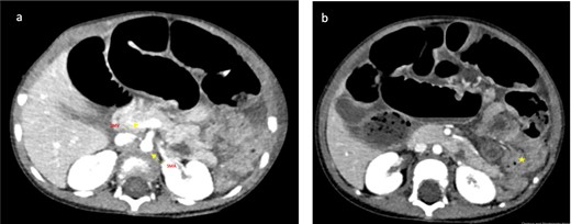 (a, b) Axial CT images: (a) The yellow arrows demonstrate the superior mesenteric vein (SMV) located slightly anterior and to the left of the superior mesenteric artery (SMA). The SMV should be positioned to the right of the superior mesenteric artery SMA. Reversal of the SMA/SMV relationship is classically associated with intestinal malrotation. (b) Yellow star demonstrates collapsed large bowel loops which are seen predominantly to the left of the midline, caecum could not be confidently identified.