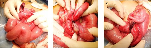 (a–c) Intraoperative photographs demonstrating (a) Meckel’s diverticulum, (b, c) The band arising from the diverticulum (mesodiverticular band associated with Meckel’s diverticulum) which resulted in small bowel obstruction.