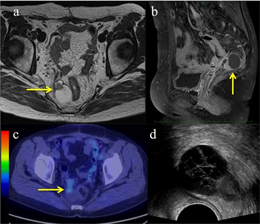 Pre-treatment images of the recurrent endometrial cancer. (a–b) Magnetic resonance imaging showing a tumour with a parenchymal and cystic component (yellow arrows): (a) Axial view of a T2-weighted image; (b) Sagittal view of a T1-weighted contrast-enhanced image; (c) Fluorodeoxyglucose uptake showing the parenchymal component of the tumour on positron emission tomography (yellow arrow); (d) Axial image of the transrectal ultrasound.