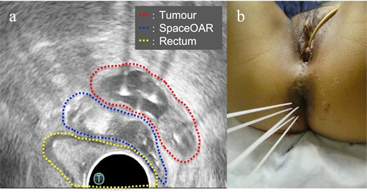 (a) Axial view of the transrectal ultrasound after implantation of the SpaceOAR hydrogel spacer and interstitial needles. This shows that the SpaceOAR is placed in an optimal position between the tumour and rectum; (b) Image of the interstitial brachytherapy.