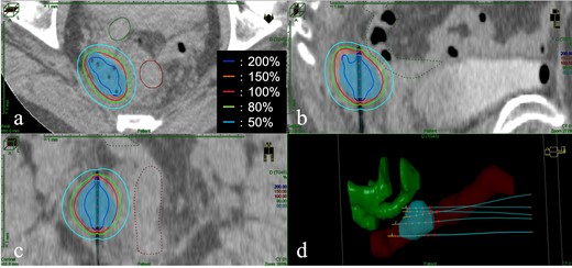 The image of dose distribution of interstitial brachytherapy. (a) Axial view; (b) Sagittal view; (c) Coronal view; (d) Three-dimensional reconstruction of the target, organ at risk, and five interstitial needles. Light blue shading: clinical target volume; brown lines and shading: the rectum; green lines and shading: the small bowel. The red line is the 100% (6 Gy) isodose line.