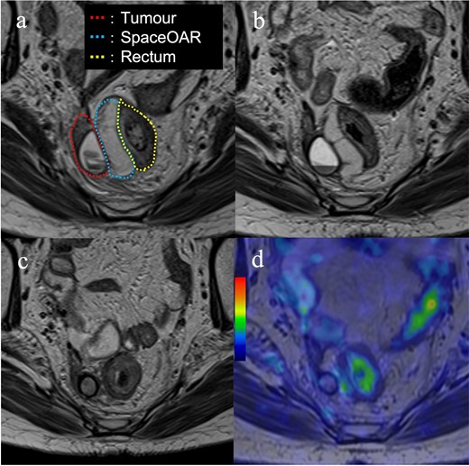 Images of the magnetic resonance imaging during and after treatment. (a) Four days after the first interstitial brachytherapy (red dotted line; tumour, blue dotted line; SpaceOAR, yellow dotted line; rectum); (b) One month after treatment; (c) Four months after treatment. The SpaceOAR is absorbed completely and has disappeared; (d) Image of the positron emission tomography-magnetic resonance imaging 8 months after treatment. There is no fluorodeoxyglucose accumulation in the recurrent tumour.