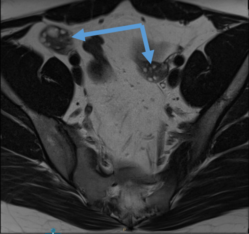Pelvic MRI revealing normal ovaries (arrow).