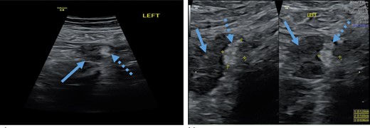 Transabdominal ultrasound revealing left ovary with a teratoma, (a) left ovary (arrow) with teratoma (dotted arrow), (b) measurement of a teratoma (dotted arrow) in the left ovary (arrow).