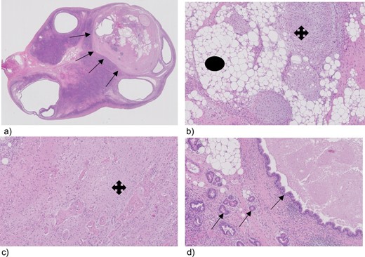 Tissue section from the lift ovary with a teratoma, (a) ovary with a teratoma (arrows), (b) teratoma, magnification 100, showing fat (circle) and cartilage (cross), (c) glial cell (cross) magnification 100, (d) glandular duct cells (arrows) magnification 100.