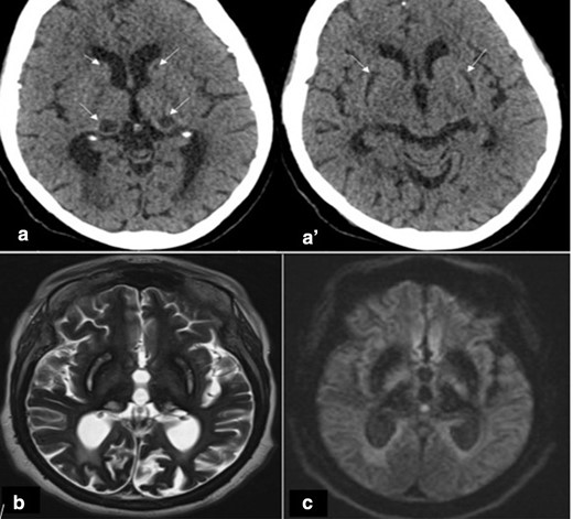 (A and A’) Axial CT scan showing hypodensity in the basal ganglia bilaterally (putamen, thalami and caudate). (B, C) Brain MRI (1,5 T): (B) Axial T2 showing hyperintense T2 signal in areas that were hypodense on CT surrounded by hypointense with also diffuse and bilateral hypointense cortices. (C) Axial diffusion showing hypo signal diffusion