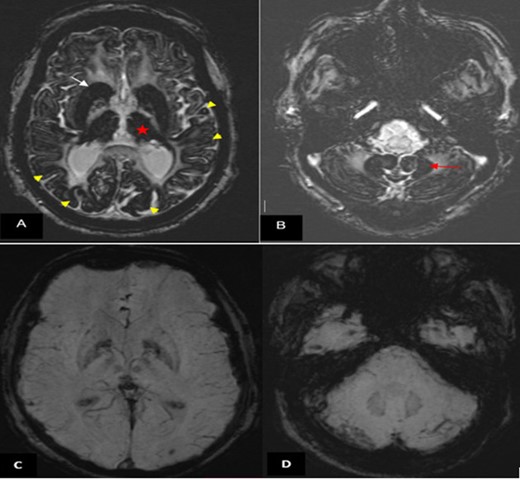 Brain MRI (1.5 T). (A, B) Axial SWI showing marked and extensive hypo intensity in the neo-striatum (white arrow), thalami (red star), cortex (yellow arrow head) (A) and dentate nuclei (red arrow (B)). (C, D) Normal SWI images in a matched patient followed for high blood pressure. SWI, susceptibility-weighted image.