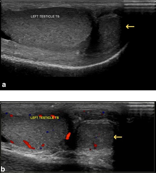 Longitudinal US image (A) and colour doppler US image (B) of the left testis showing a soft tissue mass adjacent to the left testis with similar sonographic appearances.