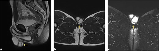 Sagittal (A) and axial (B) T2-weighted images and axial T2 fat-saturated images (C) of the scrotum. The lesion is located posterior to the left testis within the testicular sac (arrows) and is homogeneous and isointense to adjacent testicular parenchyma on all sequences.