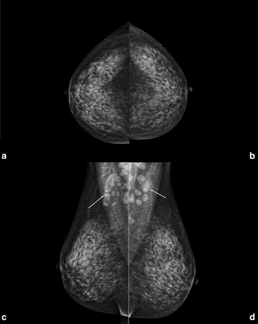 Right and left craniocaudal (A, B) and mediolateral oblique (C, D) views performed in January 2022 in a 47-year-old female attending her regular screening mammography. In the mediolateral oblique views multiple enlarged benign-appearing axillary lymph nodes are visible bilaterally (white arrows), at least 16 on the left side (the largest one of 18 mm) and at least 11 on the right side (the largest one of 33 mm). In both projections no findings suspicious for breast cancer were found.
