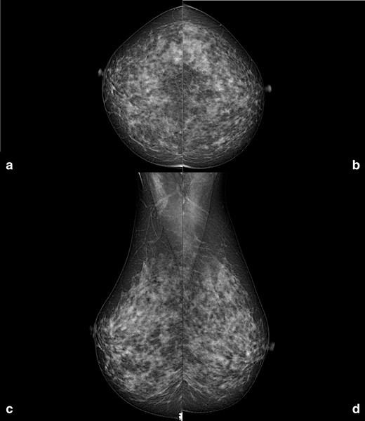 Right and left craniocaudal (A, B) and mediolateral oblique (C, D) mammographic views performed in July 2017. Neither enlarged axillary lymph nodes, nor breast suspicious findings are visible.