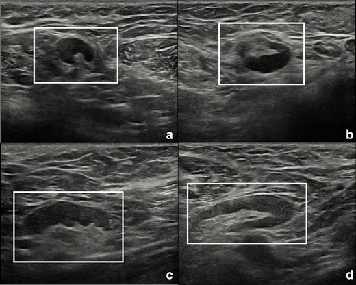 Ultrasound scans of right (A, B) and left (C, D) armpits showing lymph nodes with short to long axes ratio <0.5 (white rectangles). Oval shape, bilateralism, and visible fatty hilum are suggestive for a benign, reactive aetiology.