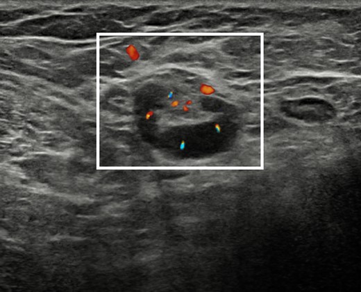 Ultrasound scan with Doppler signal overlapped on B-mode images of the right armpit showing an enlarged lymph node with increased intra- and extranodal vascularization and congested hilum (white rectangle), suggestive for active inflammation.
