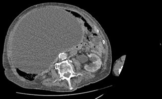 Axial CT image showing a massive homogeneous cystic mass. The wall of this large mass is thin, regular, and smooth and consistent with a fluid-filled mass.