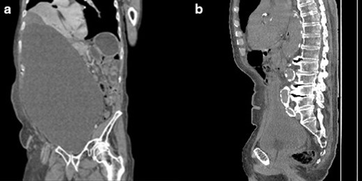 (a)Coronal CT image of abdomen and pelvis showed a better representation of the pelvic cystic mass. (b) Mid-sagittal view showing that the prostate is enlarged with a size of 4.3x 5.3 cm x 4.3 cm and a volume of 48.995 cm3.