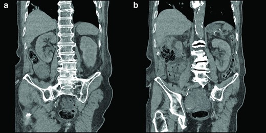 Coronal view of the right kidney (a) and the left kidney (b) before catheterization. The images show that the right kidney was normal and hydronephrosis of the left kidney.