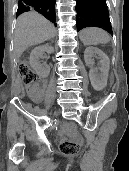 Coronal unenhanced CT image showing that post catheterisation there has been decompression of the grossly distended urinary bladder and a normal left kidney. The urinary bladder is hypertrophied and patulous secondary to chronic obstruction.
