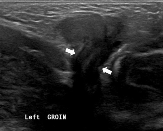 Grayscale ultrasound image showed a defect in the left inguinal area with a herniated uterus.