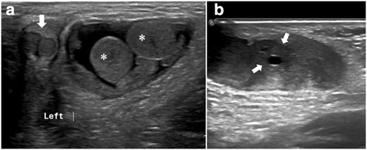(a) Grayscale ultrasound images. A hernial sac containing two testicles (asterisk) and a partially scanned phallus with two corpora cavernosum (arrow). (b) An ovary containing small peripheral follicles (arrows).