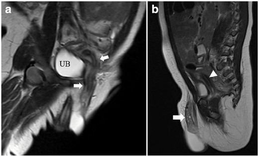 High-resolution T2 weighted MRI. (a) Coronal oblique image showing an elongated herniated uterus with normal zonal anatomy. (b) Sagittal image showing an ovary with multiple follicles (arrows) within the hernial sac and part of the uterus (arrowheads) posterior to the urinary bladder. UB, urinary bladder.