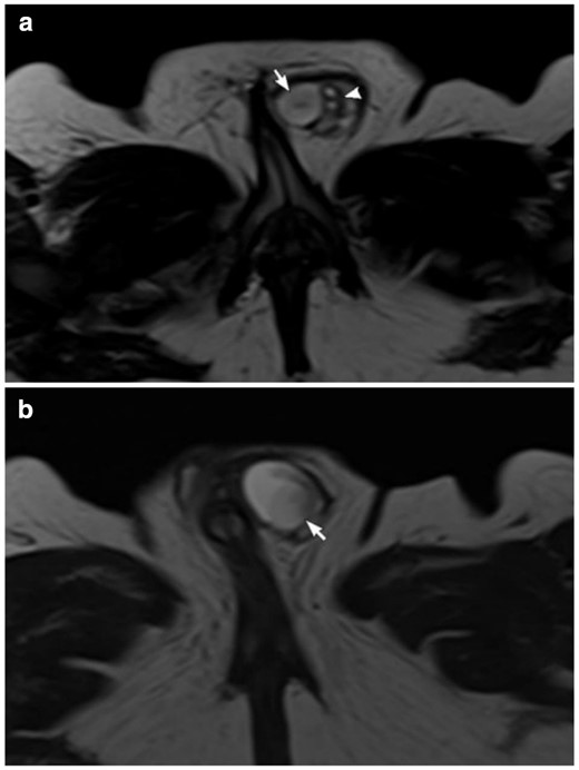 High-resolution T2 weighted MRI (a, b). Axial cuts in two different levels showing the testicles(arrows). Two small extratesticular cysts lateral to the testis (arrowhead) that could represent follicles in a small ovary or epididymal cysts.