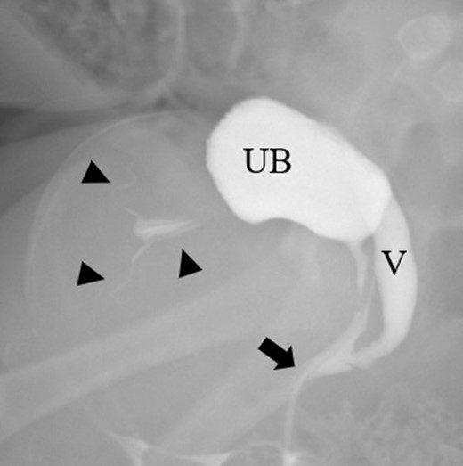 A selected image from fluoroscopic genitogram showing a urogenital sinus with a short common channel (arrow) and opacification of the urinary bladder (UB), vagina (V), endometrial cavity, and fallopian tubes (arrowheads).