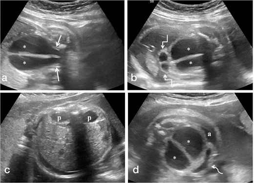 (a-d). Antenatal ultrasound images in coronal plane (a,b) showing the distended vagina (*) with central echogenic vertical septum funneling towards the pelvis (straight arrows) and distended hemiuteri at the cranial aspect of distended vagina (square arrows). Images in the axial plane (c,d) reveal bilateral renal pelvic dilatation (p) and anteriorly displaced urinary bladder (curved arrow) with fetal ascites (a).