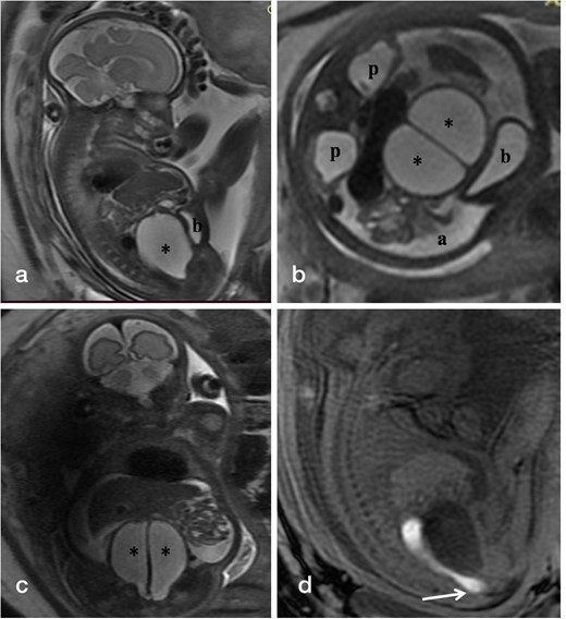 (a-d). T2-weighted fetal MR images in sagittal (a), axial (b), and coronal (c) planes show the distended vagina (*) with central linear hypointense vertical septum displacing the bladder (b) anteriorly against the abdominal wall, bilateral renal pelvic dilatation (p) and fetal ascites (a). Sagittal T1-weighted MR image (d) reveals hyperintense meconium within non-dilated rectum seen reaching upto the perineum.