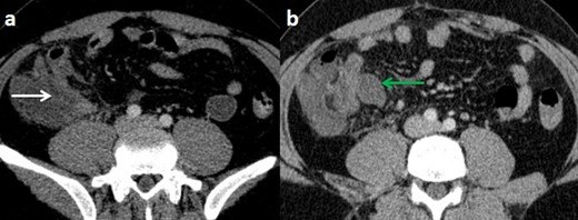Computed tomography scan of the abdomen with intravenous contrast at portal phase (with no oral contrast) on axial plan (a,b) showing an enlarged and thick-walled appendix (white arrow), with a fluid collection in the latero cecal region (green