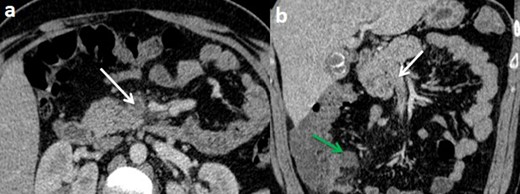 Computed tomography scan of the abdomen with intravenous contrast at portal phase (with no oral contrast) on axial plan (a) and coronal reconstruction demonstrating non-enhancing low-attenuation thrombi within the blood vessel lumen of the superior mesenteric vein and its branches (white arrows) with a fluid collection in the latero cecal region (green arrow).
