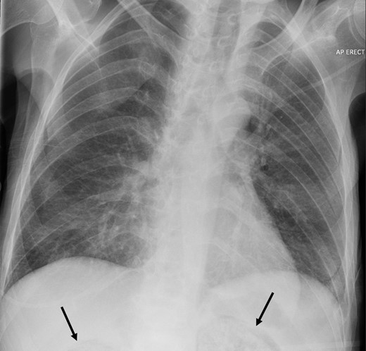 Portable erect chest radiograph demonstrating the presence of gas in the partially imaged upper pole of the kidneys.