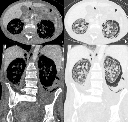 (a–d) I.V. contrast-enhanced CT abdomen and pelvis demonstrating extensive bilateral gaseous replacement of the normal renal parenchyma and perinephric space, consistent with emphysematous pyelonephritis. Free gas can be seen to track within the retroperitoneum, extending superiorly into the mediastinum and inferiorly along the left paracolic gutter and into the pelvis. (a) and (c) are set on soft tissue windows. (b) and (d) are on lung windows.