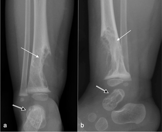 Frontal (a) and lateral (b) radiographs at presentation show a large well-defined, mildly spiculated, lobulated lytic lesion in the distal tibial metadiaphysis with a sclerotic rim (arrow). The overlying cortex is disrupted with a medium-sized extraosseous soft tissue swelling. No periosteal reaction is present. Neither the physis nor the epiphysis are affected. A similar lesion involves most of the talus (open arr).