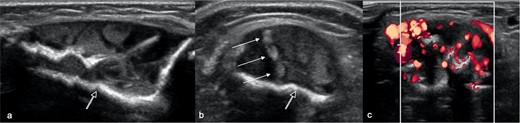 Longitudinal (a) and (b, c) transverse ultrasound images at presentation at the site of distal tibia cortical breach shows loss of the anterior cortex of the tibia with a well-defined, partially septated, intramedullary lesion, extending into the extraosseous soft tissues. The lesion comprises large cystic areas, containing rouleaux-like echogenic aggregates (arrows), and has a strongly echogenic rim (open arrow). (c) Power Doppler imaging shows moderate intralesional hyperaemia.
