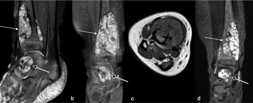 MRI of distal leg and hindfoot at presentation. (a) Sagittal, (b) coronal T 2 weighted fat-suppressed images, (c) T 1 weighted axial image and (c) coronal contrast-enhanced T 1 weighted fat-saturated image showing well-defined multilobulated avidly enhancing lesions in the distal tibia (arrow) and talus (open arrow) corresponding to the lytic lesions seen radiographically (Figure 1). There are no flow voids. These MR appearances favoured an intraosseous intermediate-flow vascular malformation.