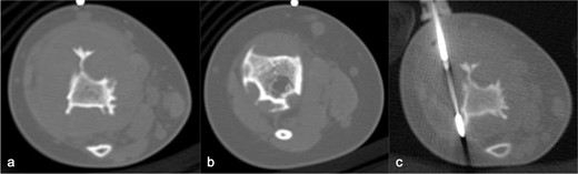 CT in axial bone window, showing multiple scalloped well-demarcated intramedullary lytic areas with sclerotic margins in distal tibia. Trucut biopsy of the soft tissue component was performed under CT guidance.
