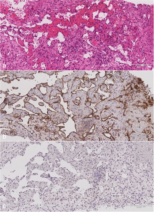 Microscopy of distal tibial biopsy. (a) H&E stain showing anastomosing blood vessels lined by endothelial cells with no significant nuclear atypia. There is no lymphatic component or bony matrix. (b) CD-31 immunohistochemical stain is positive confirming a vascular nature. (c) D2-40 immunohistochemical stain is negative indicating no demonstrable lymphatic tissue. H&E, Hematoxylin and eosin.