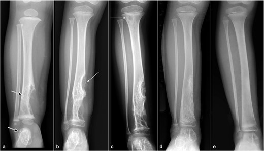 Serial radiographs at (a) presentation and (b) 1 year, (c) 2 years, (d) 2.5 years, and (e) 3 years later. (a) Initial radiograph shows a large osteolytic lesion in the distal tibia (arrow) and talus (open arrow). (b) 1 year after propranolol treatment, there is progressive osteolysis with proximal extension of the lytic area along the tibial diaphysis (arrow) and early involvement of the distal tibial epiphysis. (c) Despite escalation of propranolol treatment, there is further disease progression at 2.5 years with a new lytic subcortical lesion in the proximal tibial metaphysis (arrow) and enlargement of the lesions in the distal tibia and talus. (d) After discontinuing propanolol and 6 months of sirolimus monotherapy, there is substantial regression of the osteolysis. The proximal tibial metaphyseal lesion is no longer apparent. (e) After 1 year of sirolimus treatment, the distal tibial lesions have near-completely resolved with the tibial contour returning to normal and no soft tissue swelling. The talar lesion is smaller.