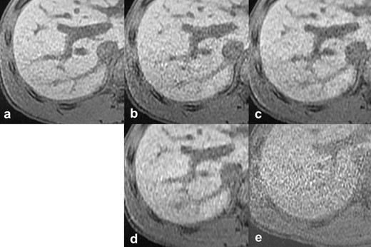 Reference images of the outline of the liver. The vs), scan time, CS factor, and total PI factor of each reference image are: (a) reference standard, 20 s scan, (b) vs 4, 10 s scan, CS 1.2, PI 4.0, (c) vs 3, 10 s scan, CS 1.55, PI 3.1, (d) vs 2, 6 s scan, CS 2.0, PI 4.0, (e) vs 1, 6 s scan, CS 1.5, PI 6.0. CS, compressed sensing; PI, parallel imaging; vs, visual score.