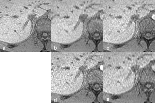Reference images of the outline of the IRHV. The vs, scan time, CS factor, and total PI factor of each reference image are: (a) reference standard, 20 s scan, (b) vs 4, 10 s scan, CS 2.0, PI 2.4, (c) vs 3, 10 s scan, CS 1.55, PI 3.1, (d) vs 2, 10 s scan, CS 1.2, PI 4.0, (e) vs 1, 6 s scan, CS 2.0, PI 4.0. CS, compressed sensing; IRHV, inferior right hepatic vein; PI, parallel imaging; vs, visual score.