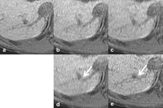 Reference images of pseudo structures of the IRHV. The vs, scan time, CS factor, and total PI factor of each reference image are: (a) reference standard, 20 s scan, (b) vs 4, 10 s scan, CS 1.55, PI 3.1, (c) vs 3, 10 s scan, CS 2.0, PI 2.4, (d) vs 2, 6 s scan, CS 2.0, PI 4.0, (e) vs 1, 10 s scan, CS 1.2, PI 4.0. There was continuity between the IRHV and other vessels, as if a portal venous shunt (arrows). CS, compressed sensing; IRHV, inferior right hepatic vein; PI, parallel imaging; vs, visual score.