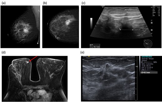 51-year-old female with a symptomatic right breast mass. Mammogram (BI-RADS b, scattered fibroglandular density) showed a 35 mm spiculate mass in the right upper outer quadrant Figure 3a and (b (Figure 2a and b), measuring up to 19 mm on ultrasound (Figure 2c) Figure 3c 14G core biopsy confirmed Grade 2 invasive NST. BCS was performed and histology showed a 60 mm Grade 3 NST with adjacent satellite nodules. The discrepancy in size between imaging and histology prompted post-operative breast MRI which demonstrated a 9 mm irregular enhancing mass in the right medial breast, distant from the site of surgery Figure 3d(Figure 3d). Second look ultrasound showed a corresponding 7 mm ill-defined mass in the medial right breast (Figure 3e). Figure 3e Core needle biopsy showed high-grade DCIS, and the patient proceeded to completion mastectomy. Final histology confirmed high-grade DCIS measuring 14 mm without invasive malignancy. BCS, breast conserving surgery;
