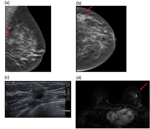 48-year-old female with a left breast lump and skin dimpling. Tomosynthesis shows an 18 mm mass in the lateral left breast (Figure 3a and b). Figure 3a and (bcorrelating with the clinical abnormality in a BI-RADS (c) (heterogeneously dense) breast. Ultrasound confirmed a hypoechoic solid mass suspicious for malignancy (Figure 3c). Ultrasound-guided 14G biopsy demonstrated Grade 2 invasive carcinoma (NST). Histology of the WLE specimen showed tumour involvement of the superior and medial margins and re-excision revealed persistent tumour involvement of the new resection margins. At this point, MRI was performed. MRI showed a 9 mm enhancing nodule at the site of surgery, suspicious for residual disease. A second lesion was seen remote from the surgical resection cavity in the lower outer quadrant, measuring 11 mm (Figure 3d). Second look ultrasound was normal, so MRI-guided biopsy was performed which confirmed invasive carcinoma with a similar histology profile to the original tumour. Completion mastectomy confirmed distant disease in the ipsilateral breast away from the surgical site. WLE, wide local excision.