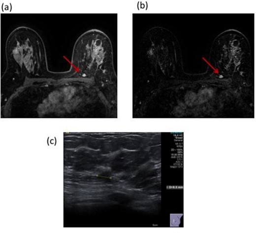 53-year-old female with a left breast mass. Mammography with density BI-RADS (b) demonstrated a 16 mm mass with a corresponding 22 mm solid mass on ultrasound. 14G core biopsy confirmed invasive NST. Following BCS, histology confirmed these findings but with involvement of the inferior margin. A post-operative MRI revealed suspicious enhancement at the surgical resection site with a further 10 mm area of enhancement posteriorly on both T1 non-subtracted (Figure 4a) and T1 subtracted post-contrast images (Figure 4b). This demonstrated Type II enhancement characteristics. Second look ultrasound detected a corresponding 8 mm indeterminate hypoechoic lesion (Figure 4c). Core biopsy revealed normal breast tissue only (B1). The patient underwent re-excision of the surgical cavity (all margins) but had no residual disease and has no evidence of recurrence after 4 years of follow-up with annual mammography. BCS, breast conserving surgery.