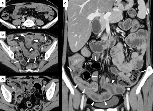 Imaging of ileitis without colitis in a 51-year-old female with metastatic breast cancer treated with Atezolizumab. Contrast-enhanced CT (CECT) at baseline did not show abnormalities of the last ileal loops wall (A). After 3 month of therapy, CECT showed a marked wall thickening, edema, and stratification involving the distal ileal loops (white arrowheads in B and C), without signs of colitis (white arrows in B and C, which show a regular colonic wall). After treatment discontinuation, CECT showed a remission of the ileitis (D). White asterisk in C shows the ileocecal valve.